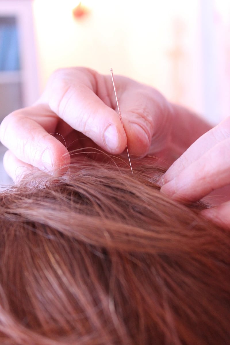 Acupuncture Benefits